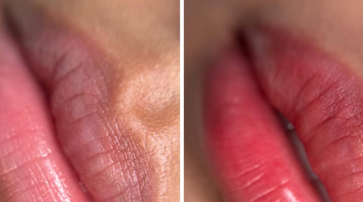 before after lip tattoo correction