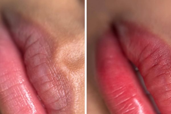 Can A Lip Liner Tattoo Correct Minor Asymmetry Or A Crooked Lip Border Caused By Scarring?