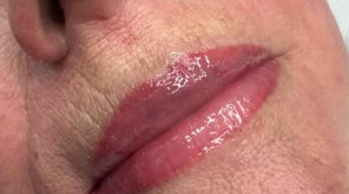 before and after lip filler results