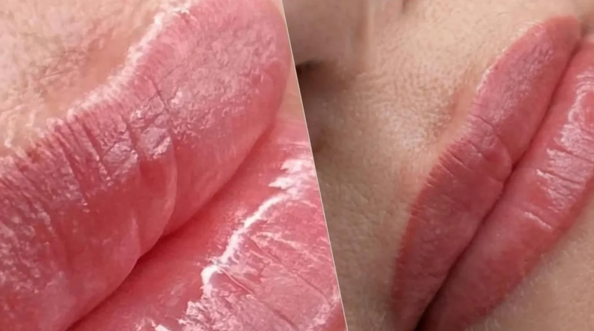 cleft lip tattoo before after men