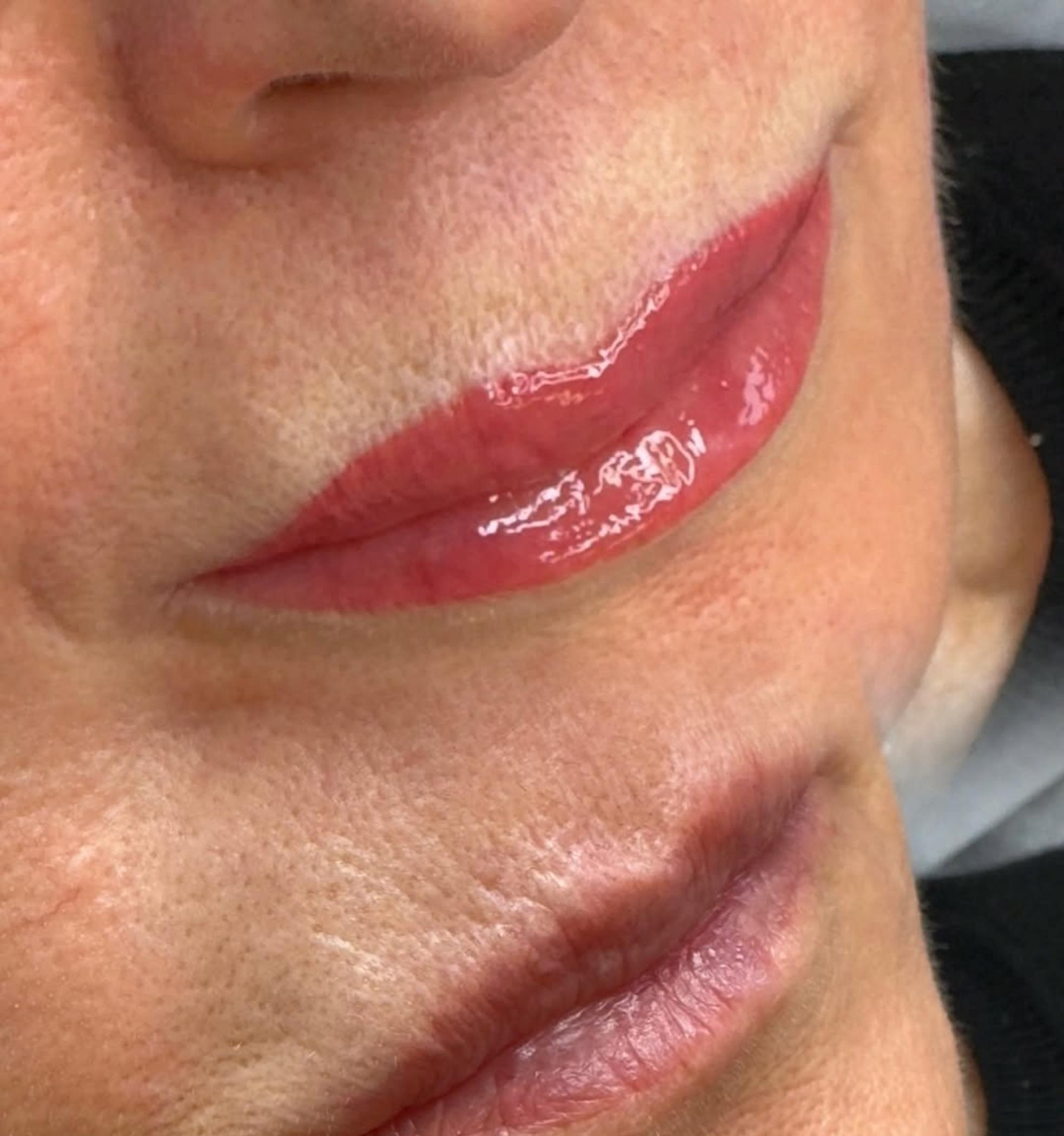 close up cold sore on lip