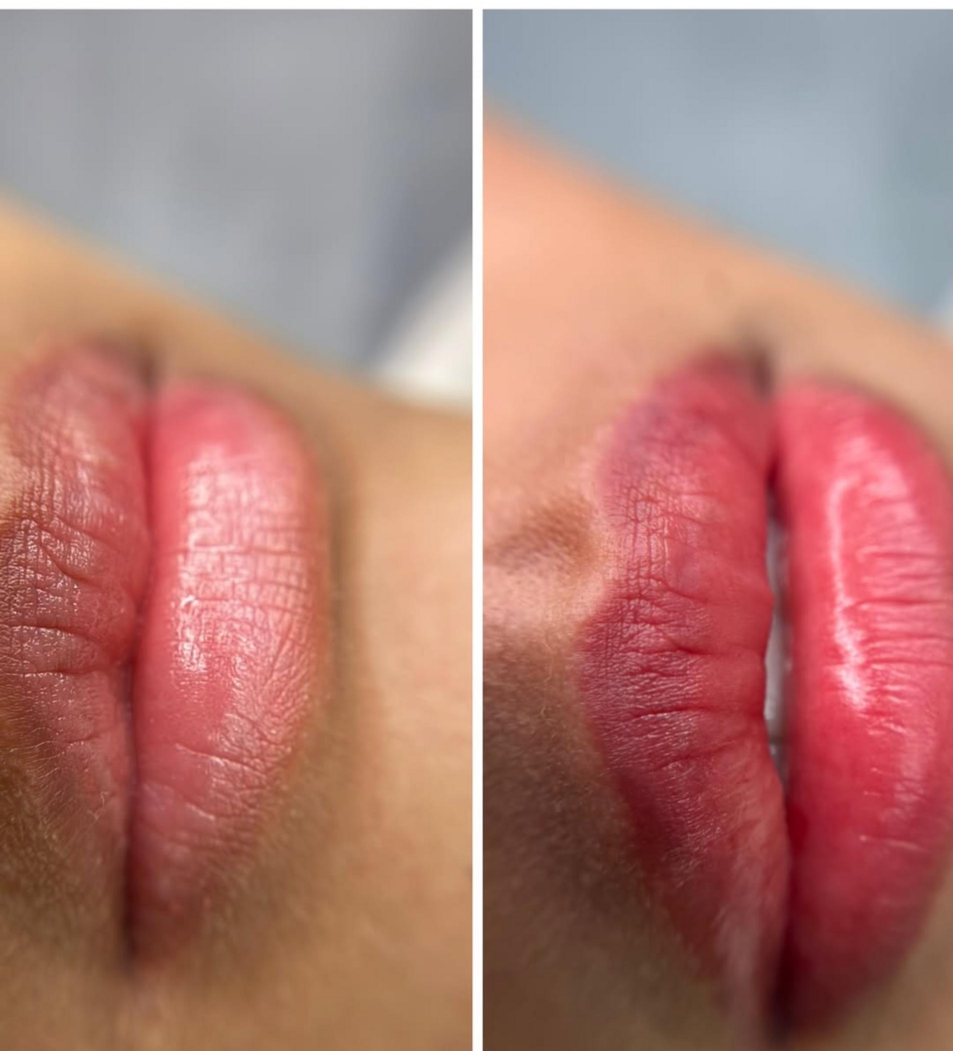 close up healed lip scar detail