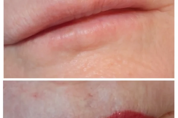 Lip Tattoo Cold Sore Prevention In Australia