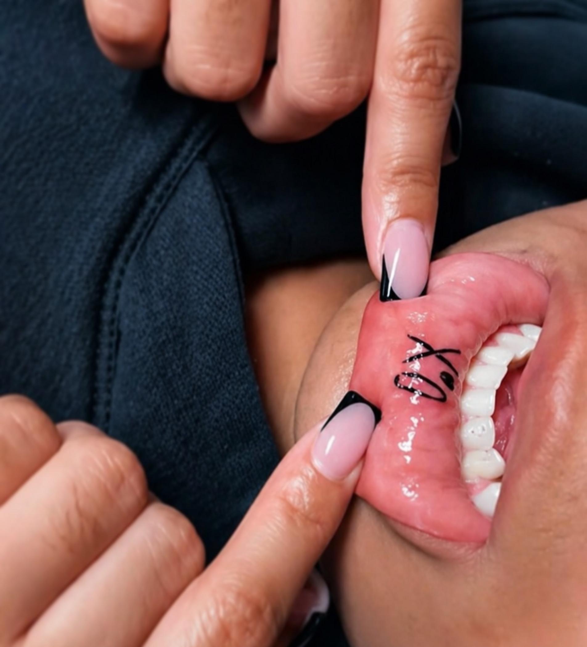 lip blush procedure in progress