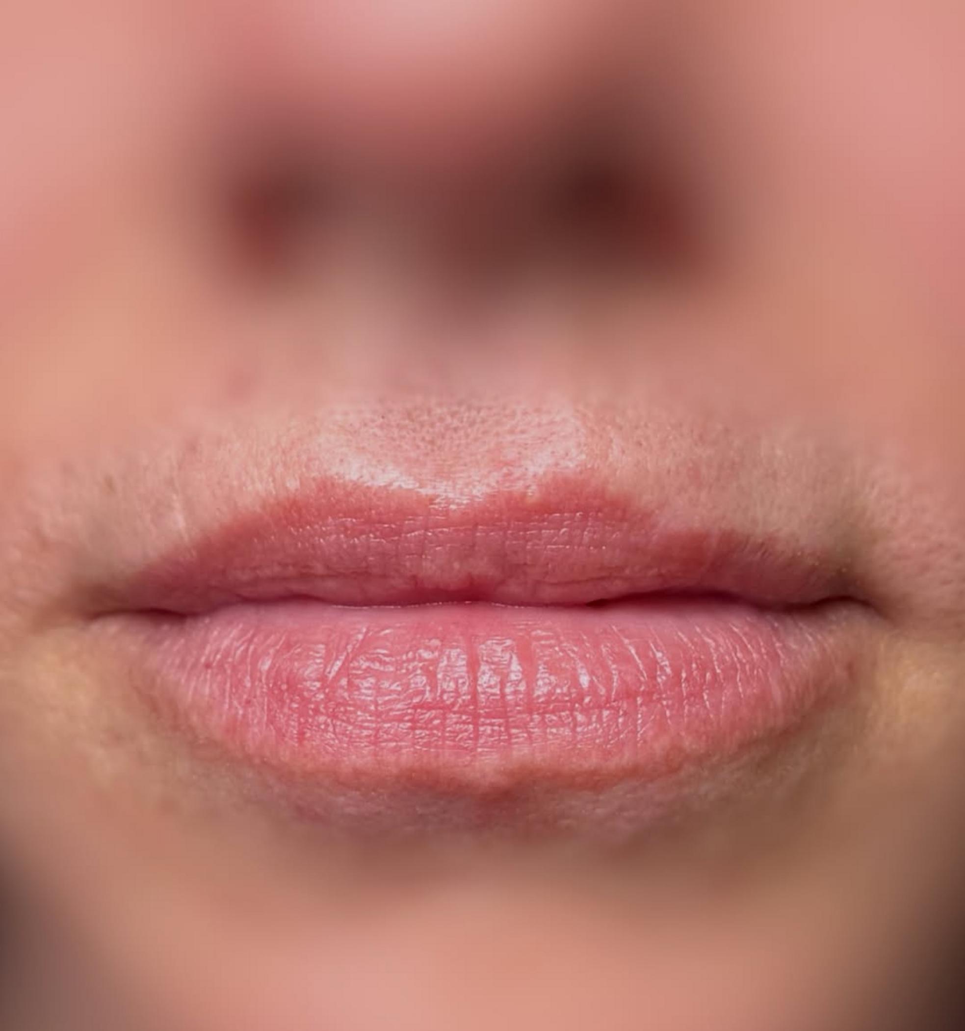 natural lip shape after fillers