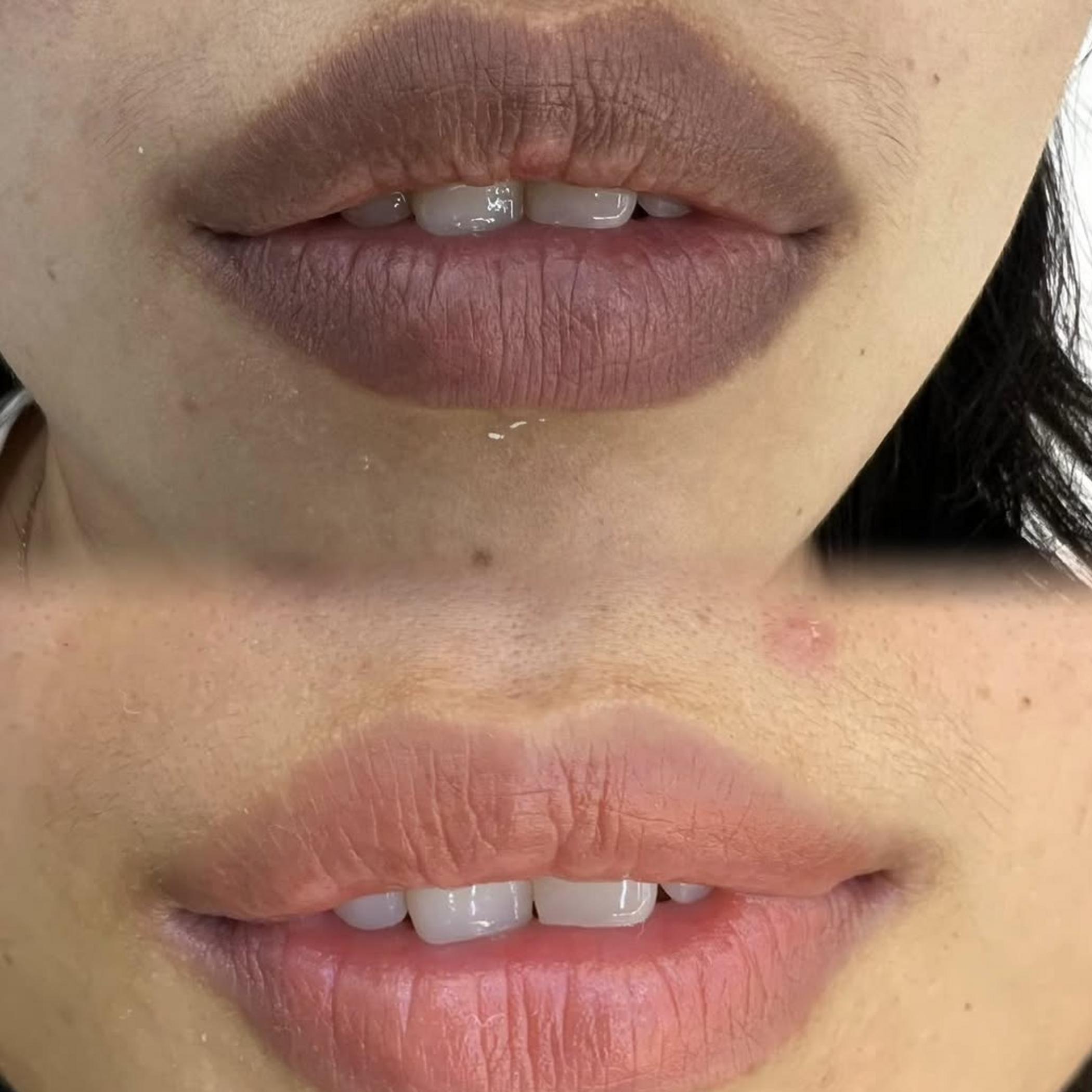 technician applying lip liner tattoo