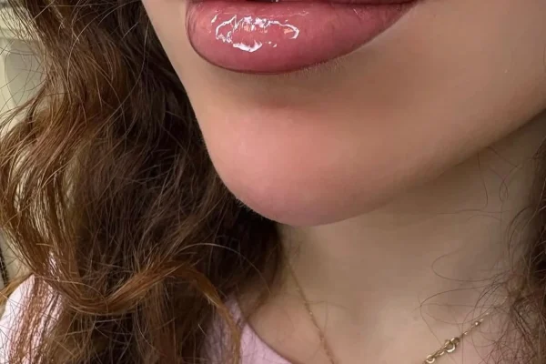 Dark Lip Neutralisation In Brisbane : The Cost, What To Expect And Real Results