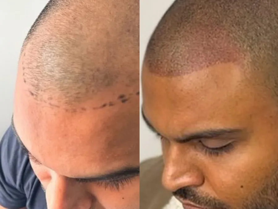 Permanent Makeup