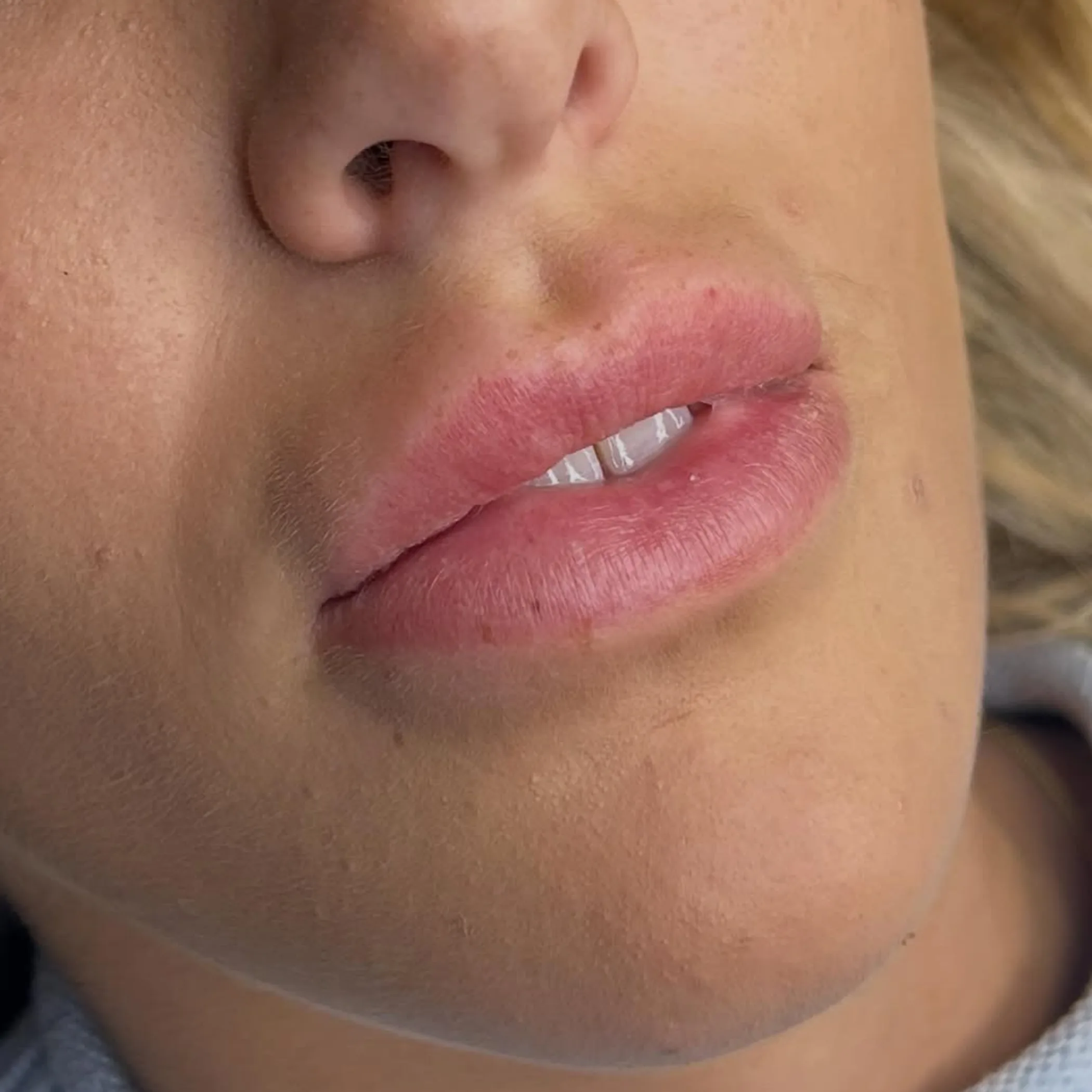 professional lip numbing application process