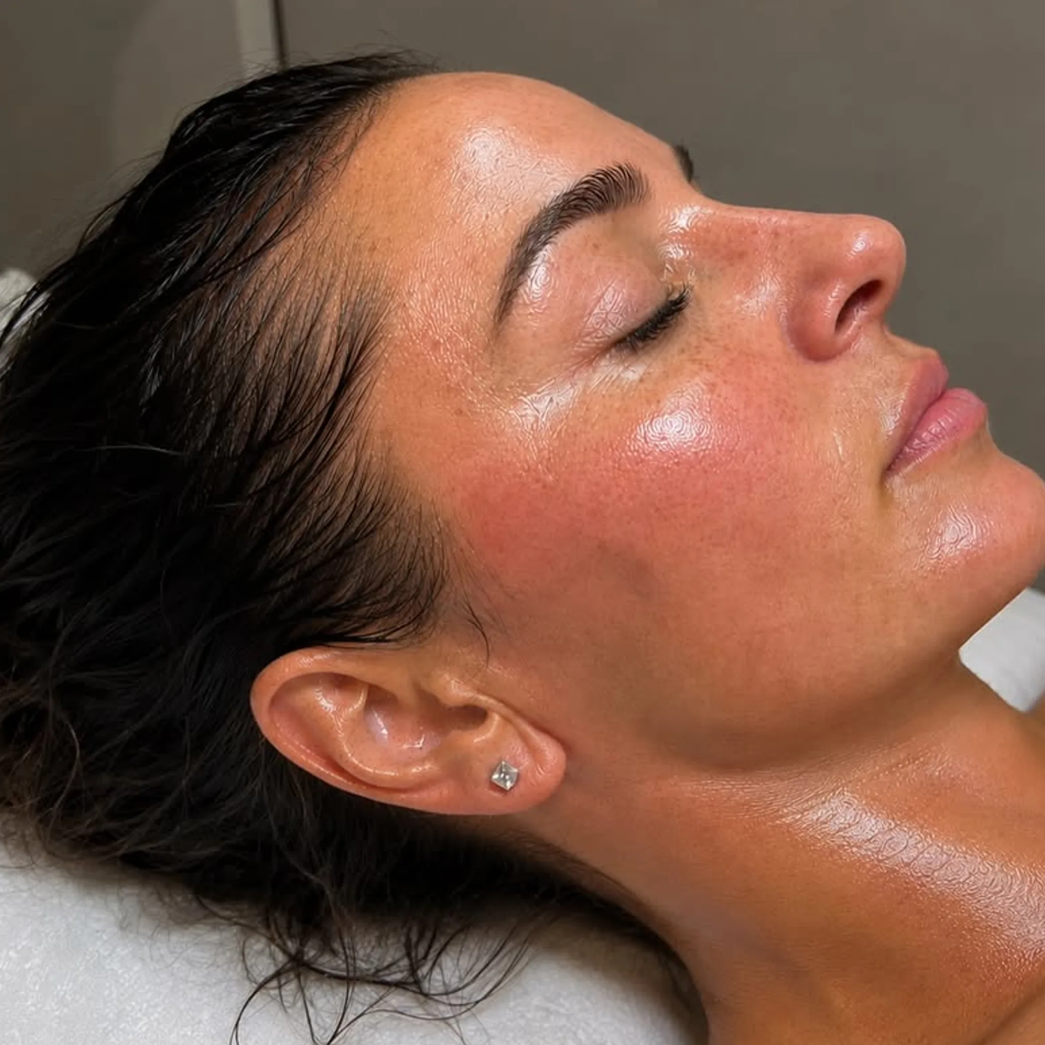 glowing skin after ipl treatment